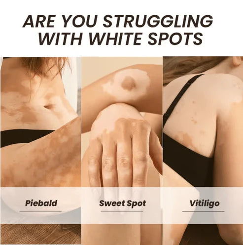 Sumifun - Vitamine Vitiligo Cream (Original)